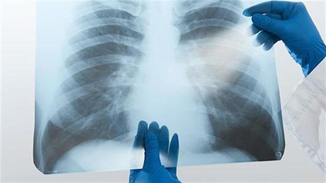 Η πνευμονία της COVID-19 είναι πιο θανατηφόρος επειδή εξαπλώνεται σαν πυρκαγιά