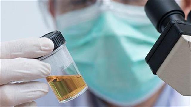 Διάγνωση καρκίνου στον προστάτη από εξέταση ούρων