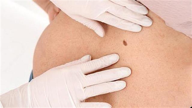 Ετήσιο δερματολογικό check-up: Πότε είναι αναγκαίο;