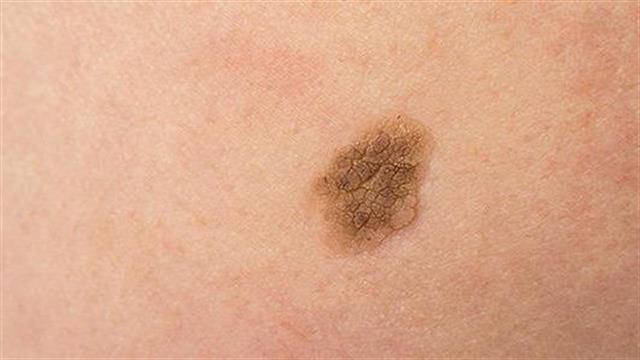 “Ελιές” της γήρανσης - Πόσο επηρεάζουν την ψυχολογία μας;