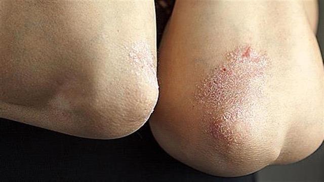 Έγκριση από την Ευρωπαϊκή Επιτροπή για βιο-ομοειδές του adalimumab