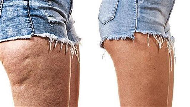 Χαλάρωση και κυτταρίτιδα λόγω ...lockdown: πώς αντιμετωπίζονται;