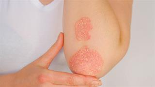 Έρευνα συνδέει την ψωρίαση με αυξημένο κίνδυνο νόσου του θυρεοειδή