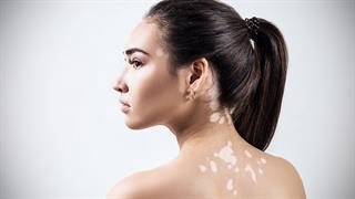 Ποιες αλλαγές στο δέρμα προειδοποιούν για θυρεοειδοπάθεια;