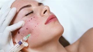 Υαλουρονικό οξύ: Όλα όσα πρέπει να γνωρίζετε