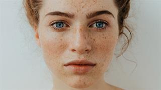 Φακίδες και κηλίδες: Υπάρχει θεραπεία;