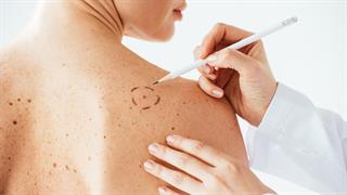Οι μισοί καρκίνοι στο δέρμα ανακαλύπτονται τυχαία κατά τον δερματολογικό έλεγχο