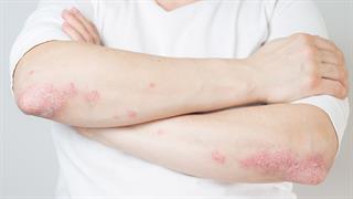 Διατροφή στην ψωρίαση: Πώς μπορεί να μας βοηθήσει