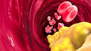 4 στους 10 μεσήλικες χωρίς γνωστή καρδιοπάθεια έχουν λιπαρές εναποθέσεις στις αρτηρίες