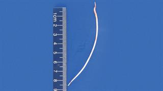 Στα Eπείγοντα με κομμάτι τσιμέντου 10 εκατοστών να του τρυπά την καρδιά