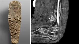 Βρέθηκε η πρώτη μούμια με δεμένη πληγή