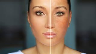 Microneedling: Θεραπεύει το μέλασμα;