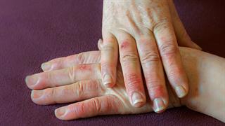 Κακή κυκλοφορία αίματος: Ποια είναι τα αίτια