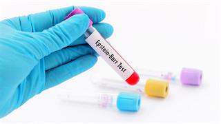 Πολλαπλή σκλήρυνση: Υποσχόμενο φαίνεται φάρμακο που στοχεύει τον ιό Epstein-Barr