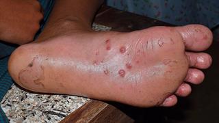 ΕΟΔΥ: Η ευλογιά των πιθήκων και η μεταδοτικότητα του ιού