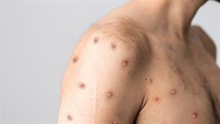 ΠΟΥ: Η ευλογιά των πιθήκων δεν θα εξελιχθεί σε πανδημία- Υπάρχουν όμως πολλά άγνωστα στοιχεία 