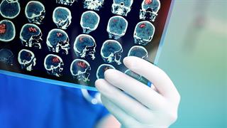 Καινοτόμο φάρμακο προάγει την αποκατάσταση του νευρικού συστήματος σε πειραματόζωα με εγκεφαλικό επεισόδιο