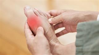 Έρευνα: Εξάρσεις ουρικής αρθρίτιδας συνδέονται με έμφραγμα και εγκεφαλικό επεισόδιο
