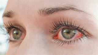 Η ευλογιά των πιθήκων μπορεί να επηρεάσει τα μάτια και την όραση