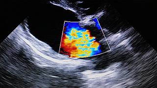 Κ. Γκατζούλης: Μυοκαρδίτιδες - αρρυθμίες και νόσηση από COVID