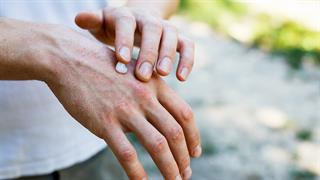 Εγκρίθηκε από τον FDA φάρμακο για τη θεραπεία της γενικευμένης φλυκταινώδους ψωρίασης