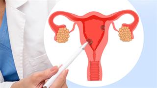 Καρκίνος του ενδομητρίου: Τα νεότερα δεδομένα για τη θεραπεία