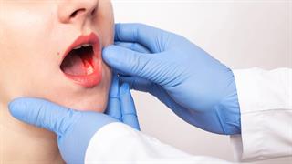 Καρκίνος του στόματος: Όλα όσα πρέπει να γνωρίζουμε