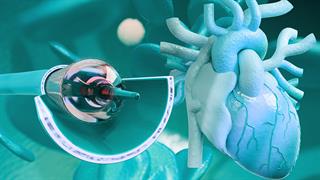 Ισχαιμική μυοκαρδιοπάθεια: Το stent δεν βελτιώνει την καρδιακή απόδοση και την επιβίωση [μελέτη]