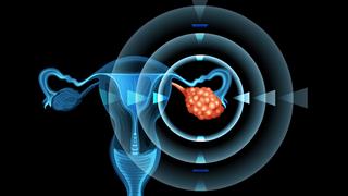 Καρκίνος ωοθηκών: Ο προσυμπτωματικός έλεγχος τον ανιχνεύει πρόωρα όχι όμως έγκαιρα [μελέτη]