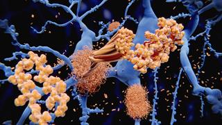 Οι  δύο φάσεις της εξέλιξης του Alzheimer