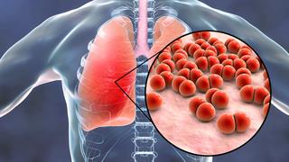 Σοβαρή λοίμωξη από πνευμονιόκοκκο αυξάνει σημαντικά τον κίνδυνο καρδιακής προσβολής [μελέτη]