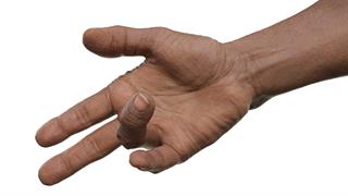 Σε γονίδια των Νεάντερταλ αποδίδεται η ''νόσος των Βίκινγκς''