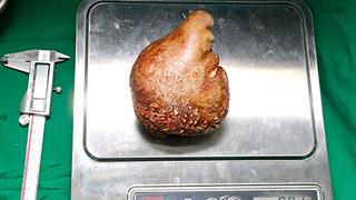 Χειρουργοί αφαίρεσαν τη μεγαλύτερη παγκοσμίως πέτρα στα νεφρά