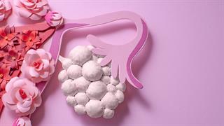 Σύνδρομο πολυκυστικών ωοθηκών: Διπλάσιος κίνδυνος για καρκίνο μετά την εμμηνόπαυση
