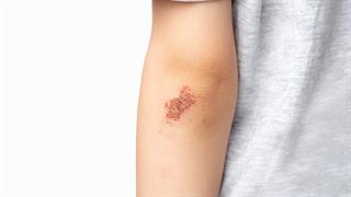 Νέα συσκευή θα μπορούσε να εντοπίζει πιο γρήγορα πληγές που έχουν μολυνθεί