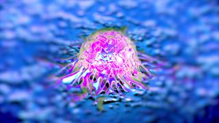 Καρκίνος του προστάτη: Η μαγνητική τομογραφία εντοπίζει όγκους ακόμη και με χαμηλά επίπεδα PSA 