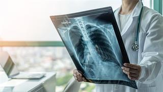 Καρκίνος του πνεύμονα: Οι μελέτες που παρουσιάστηκαν στο Συνέδριο ESMO 2023