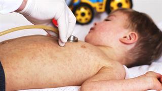 Συναγερμός λόγω εξάπλωσης ιλαράς στη Ρουμανία- κηρύχτηκε επιδημία