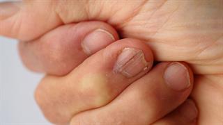 Σπάνια διαταραχή στα νύχια, λόγω CoViD - Τι είναι οι γραμμές του Beau - Ελληνική μελέτη [εικόνες]