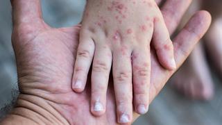 Ο ΠΟΥ κρούει τον κώδωνα του κινδύνου για την απότομη αύξηση των λοιμώξεων από ιλαρά