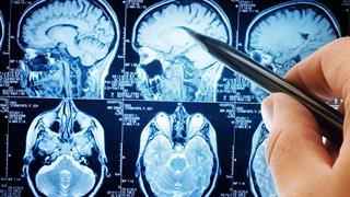 Αντιδιαβητικά φάρμακα μειώνουν τον κίνδυνο όγκων στον εγκέφαλο [μελέτη]