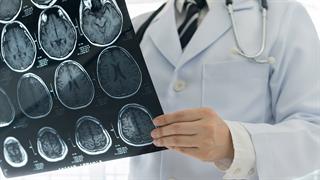 Ποιοι έχουν καλύτερη έκβαση μετά από εγκεφαλικό επεισόδιο [μελέτη]