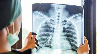 Φυματίωση: Βακτήρια στην αναπνοή ακόμη και όταν δεν υπάρχουν στα πτύελα [έρευνα-μελέτη]