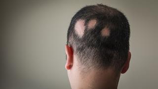 Γυροειδής αλωπεκία: Τι μπορούμε να κάνουμε