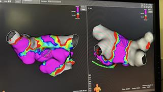 Πέντε καρδιολογικές επεμβάσεις αιχμής στο 