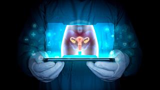 Η τεχνητή νοημοσύνη είναι πιθανό να οδηγήσει σε καλύτερη εξέταση αίματος για τον καρκίνο των ωοθηκών