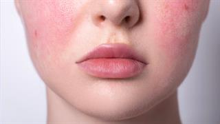 Ροδόχρους ακμή: Συμβουλές για τη διαχείριση εξάρσεων