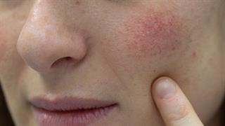 ECDC: Κρούσματα παρβοϊού Β19 σε 4 ευρωπαϊκές χώρες - Το εξάνθημα του 