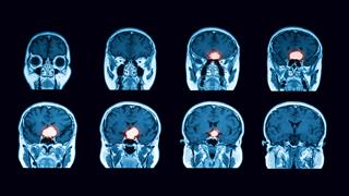 Όγκοι της υπόφυσης: Πού πρέπει να στοχεύει η χειρουργική θεραπεία