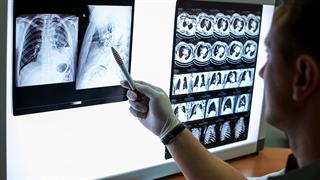 Kαρκίνος του πνεύμονα: Συνδυαστική θεραπεία μειώνει τον πολλαπλασιασμό των καρκινικών κυττάρων  